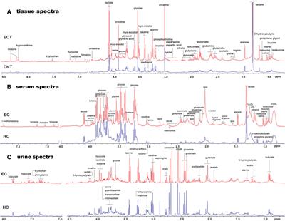 1H NMR-based metabolomics of paired tissue, serum and urine samples reveals an optimized panel of biofluids metabolic biomarkers for esophageal cancer